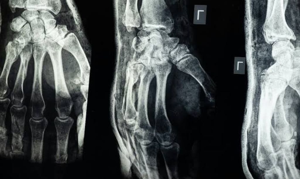 knochenkleber knochenbrueche heilen